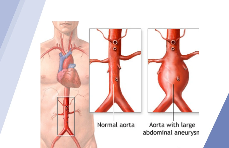 aortic_aneurysms_content_image_one_stop_vascular_solutions
